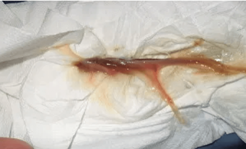 Fotografía real de un tapón mucoso retenido en un pañuelo, mostrando su textura gelatinosa característica con filamentos de sangre de tono marrón y rosado.